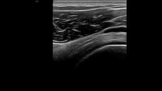 Subacromialsubdeltoid bursa ultrasound [upl. by Botzow145]