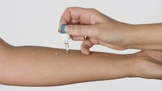 Allergie pediatriche diagnosi con il prick test  Centro Medico Santagostino [upl. by Anialed]