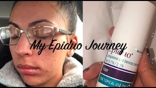 My Epiduo Journey Weeks 12 [upl. by Ninette]