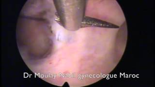 Hysteroscopic treatment of intra uterine synechia with cold scissors [upl. by Godding618]