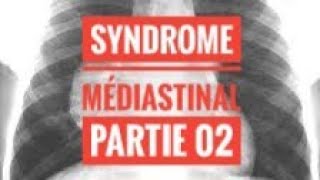 Syndrome Médiastinal  partie 02 [upl. by Kwok717]