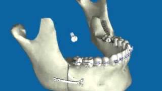 Retroceso de Mandíbula por Prognatismo Mandibular [upl. by Akenaj]