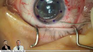 DMEK Descemets Membrane Endothelial Keratoplasty modern corneal transplant [upl. by Angle]