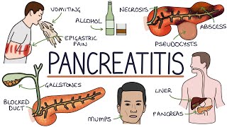 Understanding Pancreatitis [upl. by Mindi]