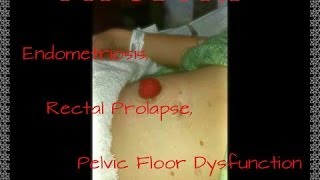 My Story Part 1 Endometriosis Rectal Prolapse Pelvic Floor Dysfunction amp Loop Ileostomy [upl. by Ab]