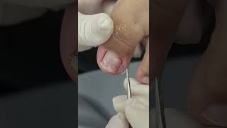 Granuloma gigante reels nails [upl. by Arbma]