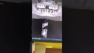 SEVERE BUCCAL LINGUAL BONE DEFECT HOW TO REHABILITATE FULL MANDIBLE WITH IMPLANTS DR C MURUGAVEL [upl. by Mayrim]