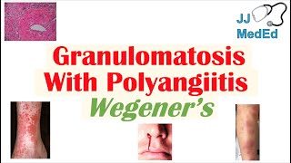 Granulomatosis with Polyangiitis Wegener’s granulomatosis  Symptoms Diagnosis Treatment [upl. by Keyes751]