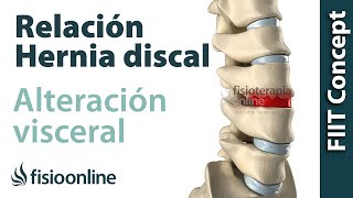 ¿Cómo se produce una hernia discal por una disfunción o alteración visceral [upl. by Ecirtal]