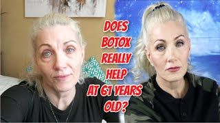 Does Botox really help at 61 years old  Dysport injection review for crows feet amp 11s  bentlyk [upl. by Elhsa]