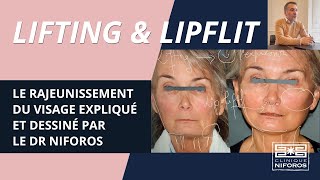 Rajeunissement du visage par lifting et liplift [upl. by Noiemad233]