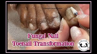 Pedicure Tutorial Thick Fungal Toenail Transformation [upl. by Ruskin]