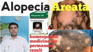 Homeopathic medicine for Alopecia areata  explain everything l permanent result l Drrakeshbharti [upl. by Arjun]