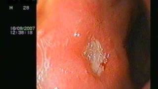 DUODENAL ULCER ON ENDOSCOPY [upl. by Aitnwahs645]