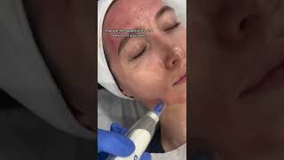 Facial Rejuvenation with MicroNeedling  Dr MediSpa [upl. by Furgeson]