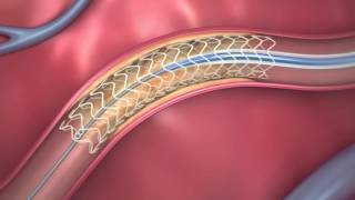 FDAApproved Dissolving Heart Stent  How It Works [upl. by Eutnoj278]