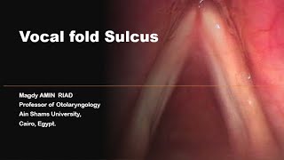 Vocal folds Sulcus [upl. by Annamaria]