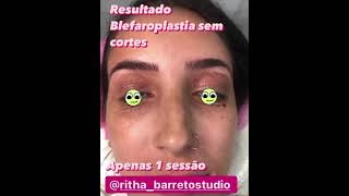 Blefaroplastia com jato de plasma [upl. by Ymmij19]