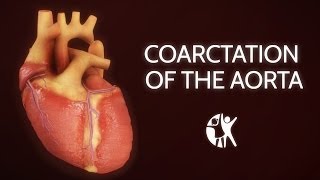 Coarctation of the Aorta [upl. by Ellinet]