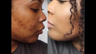 How To Cover Dark Spots Hyperpigmentation  Makeup Tutorial [upl. by Korfonta]