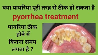 Pyrrohea treatmentक्या पायरिया पूरी तरह ठीक हो सकता हैपायरिया का इलाज tartar removalcalculus [upl. by Nylhsa918]