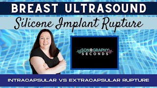 Breast Ultrasound Silicone Intracapsular vs Extracapsular Implant Rupture [upl. by Najar]