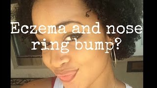 How to Get Rid Of Eczema and Nose Ring BumpKeloids [upl. by Yenahs]