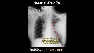 Pleural Pseudotumor  Diagnosis  CXR PA Practical case  Radiology [upl. by Eislrahc1]