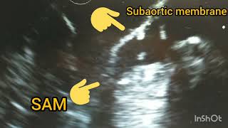 Double LVOT obstruction SAMsubaortic membrane [upl. by Anauqcaj375]