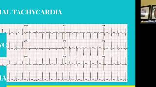 ARRHYTHMIAS [upl. by Anidam]