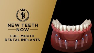 Implant Bridges Zirconia Monolithic Double Full Arch Tutorial [upl. by Garry]