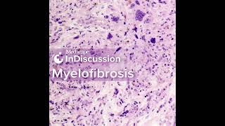 Risk Stratification in Myelofibrosis Which Model Should You Use [upl. by Odel]