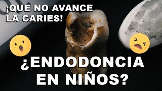 😱 ¿¿¿ENDODONCIA en Niños  Pulpotomía o pulpectomía [upl. by Mcmurry]