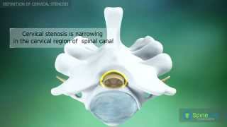 Cervical Stenosis Definition [upl. by Nyltiac]