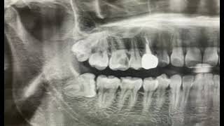 How To Extract impacted Wisdom ToothImpacted Wisdom Tooth Extraction [upl. by Mihsah]