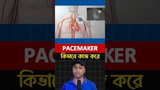 Pacemaker কিভাবে কাজ করে [upl. by Tolland106]