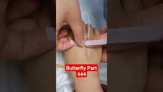 Butterfly  Part 444  Scalping shorts viral youtubeshorts medical hospital [upl. by Divine607]