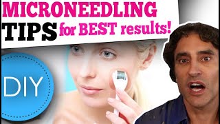 MICRONEEDLING DIY at HOME  What You Need to Know [upl. by Adkins465]