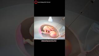 What is an amniocentesis  Amniotic fluid check up [upl. by Oiramd]