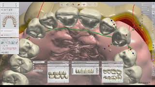 3shape full denture design [upl. by Kriste]