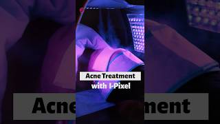 How to Improve Skin Texture  Laser Treatment for Acne  Best Dermatologist in Noida  Skinlogics [upl. by Netfa977]