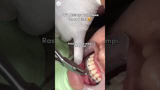 Gigi rapih tuh emang bisa bikin naikin mood everyday gak sih Bawaannya mau senyum terus 😍 braces [upl. by Nyra]