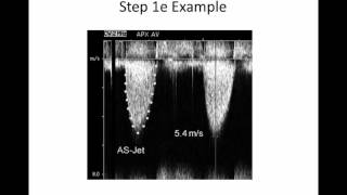 Intro to Aortic Stenosis [upl. by Anaugahs]