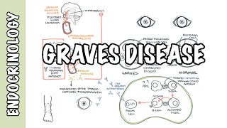 Graves Disease  Overview causes pathophysiology investigations and treatment [upl. by Killian]