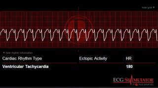 Ventricular Tachycardia ECG  EKG ecgsimulatornet [upl. by Kisung]