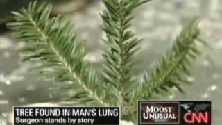 Tree Found Growing In a Mans Lungs  CNN Jeanne Moos [upl. by Atinob306]