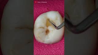 Small Teeth Cavities toothrestoration satisfying [upl. by Yelsnik]