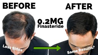 Microdosing Finasteride BREAKTHROUGH 02mg  New Dosage [upl. by Salhcin]