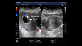 A Pregnancy of 7 weeks Ultrasound Findings [upl. by Ronni138]