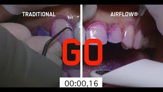 Abrasive teeth cleaning method vs AIRFLOW method [upl. by Lust]